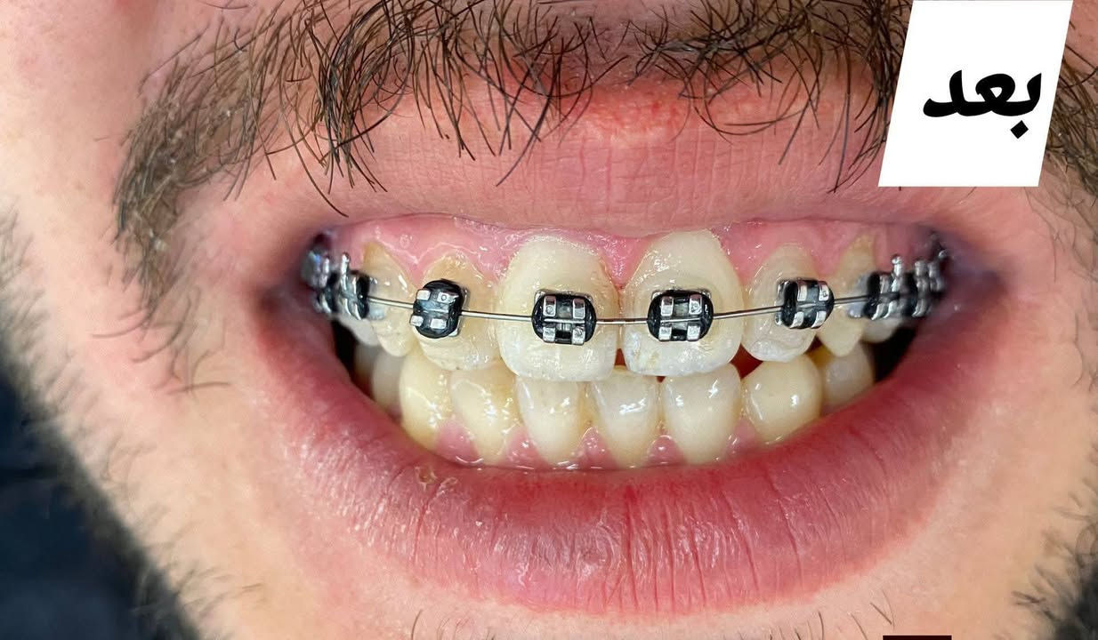 هاي النتيجة بعد ثلاث جلسات كل شهر جلسة العنوان مشيرفة الأولى صيدلية محمود مفكر قبل المنديل للحجز ***********
