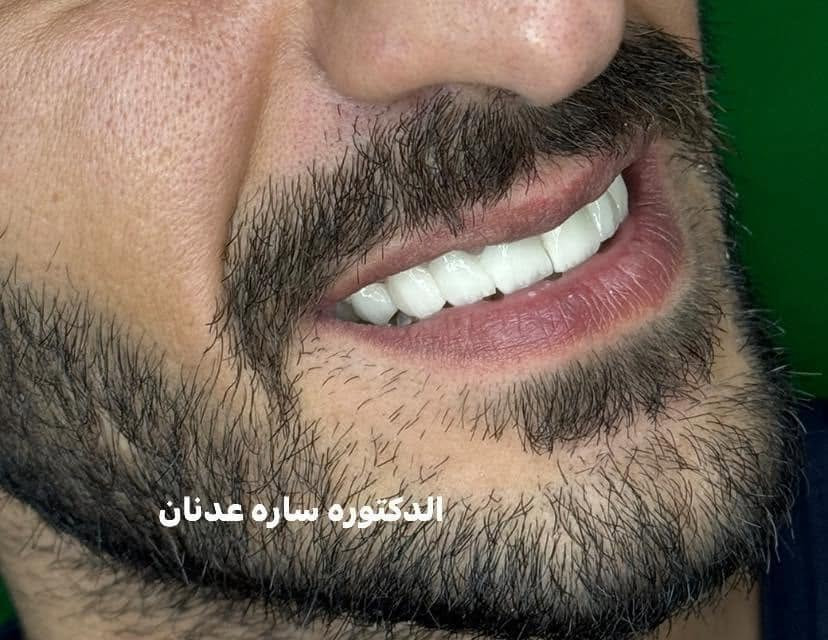 ابتسامة هوليود • زاركون ايماكس • ضمان مدى الحياة