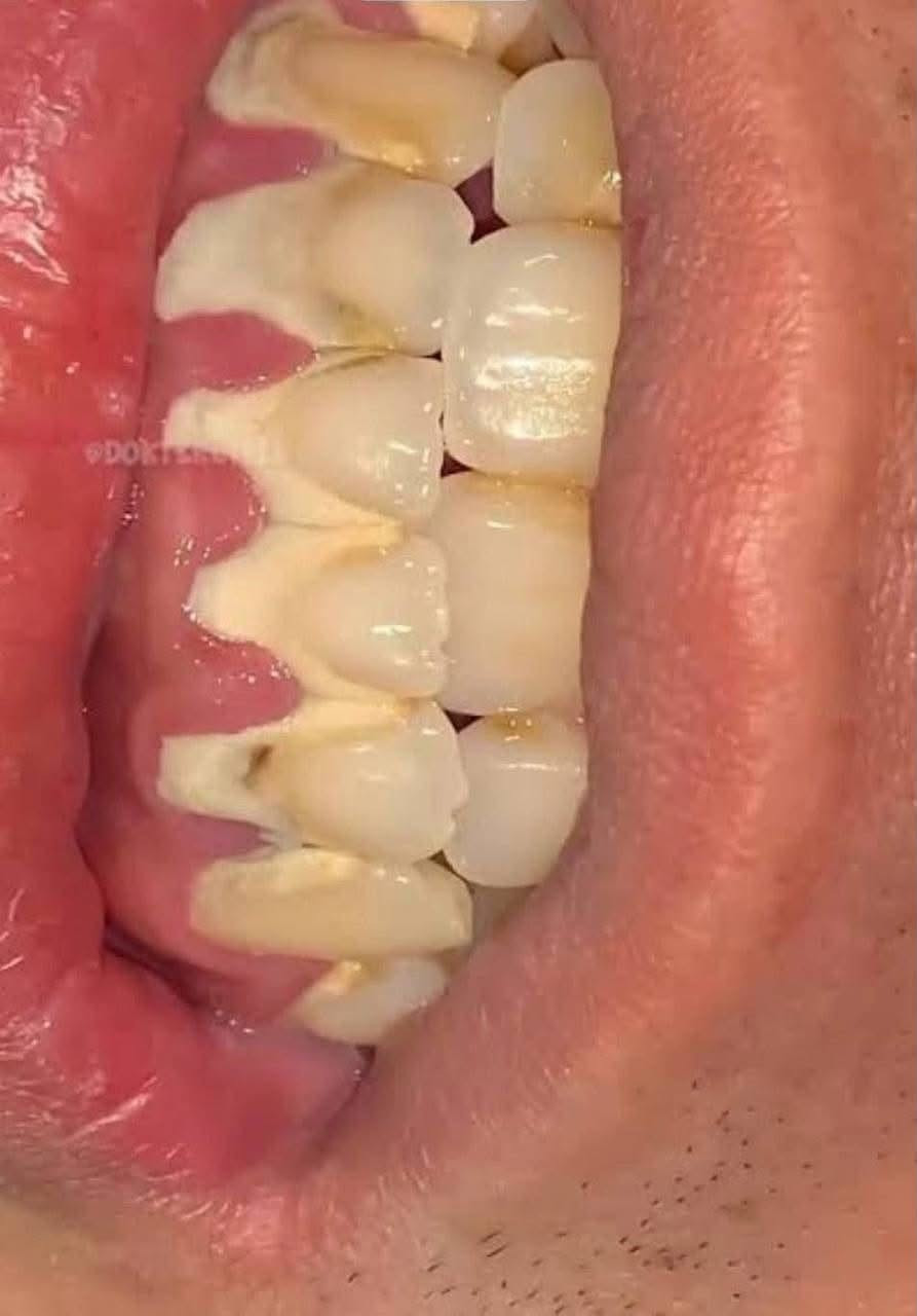 تنظيف أسنان مجاني • مثل البصورة • واتساب