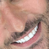 ابتسامة بدون برد • عدسات الأسنان • بغداد