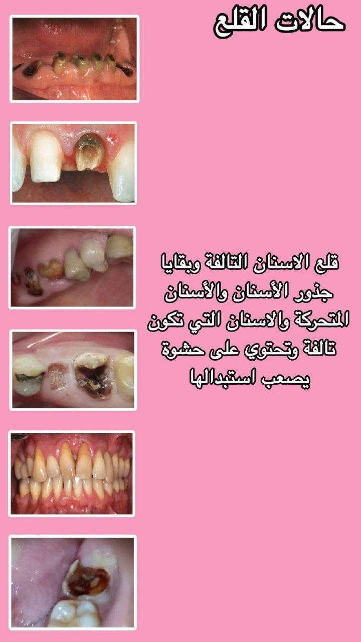 العمل مجاني
حشوات +قلع
للإستفسار التواصل على الرقم ***********

نص مكتوب في الصور:
- تسوس بين الأسنان الخلفية
- تسوس بين الأسنان الأمامية
- كسر او تسوس بالأسنان الأمامية
- حالات القلع
- قلع الاسنان التالفة وبقايا جذور الأسنان والأسنان المتحركة والاسنان التي تكون تالفة وتحتوي على حشوة يصعب استبدالها