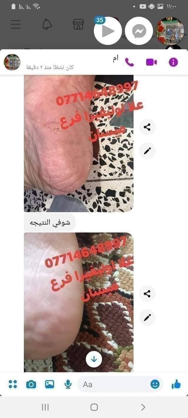 سبب حرارة الصيف واغلبيتنه راح نعاني من تشققات الاقدام وخشونتها بسبب الحراره 😞 ولا يهمكم حبايبي جبتلكم كريم علا اوليفيرا السحري المعجزه بكج كامل 🌟الي راح يخلي اقدامكم نااعمه مثل اقدام الاطفال 💎

نص مكتوب في الصور:
- +964 773 877 *********** شوفى رجلينه كلش جانت يصبن دم والله العضيم ٣ ايام خليته اله العلاج وتعالجن رجليه حتى لايده خليت صارن كلش زينات ***********97
- +964776591
- ***********
- BAN
- علا اوليفيرا!
- بان مهدي صالح
- 077
- مراسلة
- علا اوليفيرا فرع ميسان ***********
- +9647732591 *********** علا اوليفيرا ٠٥:١٧ ص بان مهدي صالح شوفي الفرق ٠٥:٢٢ ص خيه انتي رحمه من الله انطاج النه ايدج وعلاجج بي العافيه ٠٥:٢٣ ص صباح الورد ٠٥:٢٩ ص صلوات عل . محمد هآا . محمد مراسلة
- علا اوليفيرا فرع ميسان *********** هاي قبل العلاج علا اوليفيرا فرع ميسان *********** علا اوليفيرا فرع ميسان *********** هاي بعد االعلاج
- وردة
- نشط الآن
- ٧:٥٩ م
- السلام عليكم
- شخبارج
- حبيت اشوفج الفرق
- ***********
- قبل
- بعد
- علا اوليفيرا فرع ميسان
- ربي يرزقكم ان شاء الله
- ٨:١٩ م
- اللهم صلي على محمد وآل محمد
- لقد قمت بالرد على وردة
- وعليكم السلام ياقلبي
- Aa
- +964 77 2599
- ايي هم نسيت ٠٩:٣٤ م
- ***********
- هاي رجليه اليوم ٠٩:٣٤ م
- بعد استخدام مره وحده ٠٩:٣٥ م
- احسن صار ٠٩:٣٥ م
- صارن ٠٩:٣٥ م
- لصق
- مرحباً! أنا استعمل واتساب. +964 77 علا اوليفيرا فرع ميسان *********** اللهم صلي على محمد وآل محمد اخذت صوره من كلتيلي قبل ماستخدم الخلطه وعلي جان اليل ماينام من الوجع كلساعه يذب عليهن ماي لان يبسن ويشككن بس يدوس بلكاع يطكن دم وعلي نندعيلج وهوه يكول ادعي للمربه لسوتلي رجليه زينات علا اوليفيرا فرع ميسان *********** ياعمري ان شاءالله اكون عند حسن ظنكم يارب ومليون عافيه الكم ياعمري احلى شعور من تراسلوني وانتم فرحانين مراسلة
- علي اولفيرا فرع
- ميسان
- شوفي النتيجه