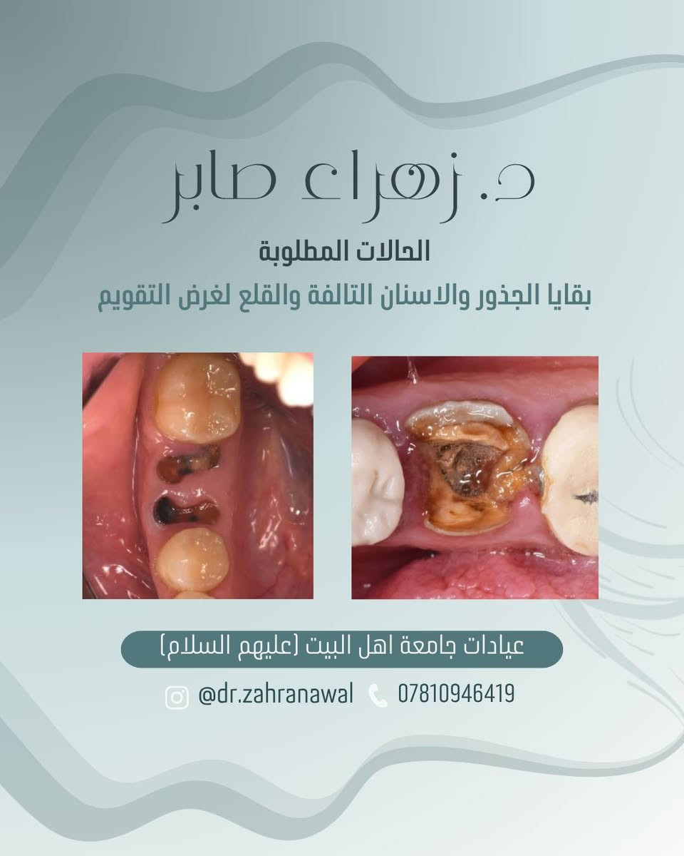 العلاج مجاناً 🤍
إذا كانت حالتكم مطابقة للحالات المطلوبة أو لديكم استفسار، يمكنكم التواصل معي عبر الخاص أو الانستغرام أو رقم الهاتف الموجود في الكارت.

أهلاً وسهلاً بكم، ونسعد بخدمتكم.

نص مكتوب في الصور:
- د. زهراء صابر
- فحص الفم والاسنان
- قلع الاسنان والجذور المتبقية
- تنظيف الاسنان وازالة التكلست
- عمل الحشوات الضوئية (تجميلية)
- تعويض الاسنان المفقودة بطقم جزئي
- عيادات جامعة اهل البيت (عليهم السلام)
- @dr.zahranawal
- ***********
- علماً العلاج مجاناً
- الحالات المطلوبة
- تمبغات او تكلسات حول الاسنان
- @dr.zahranawal ***********
- د. زهراء صابر الحالات المطلوبة تسوس في الاسنان الخلفية عيادات جامعة اهل البيت (عليهم السلام) @dr.zahranawal ***********
- تسوس او كسر في الاسنان الأمامية
- د. زهراء صابر الحالات المطلوبة بقايا الجذور والاسنان التالفة والقلع لغرض التقويم عيادات جامعة اهل البيت (عليهم السلام) @dr.zahranawal ***********