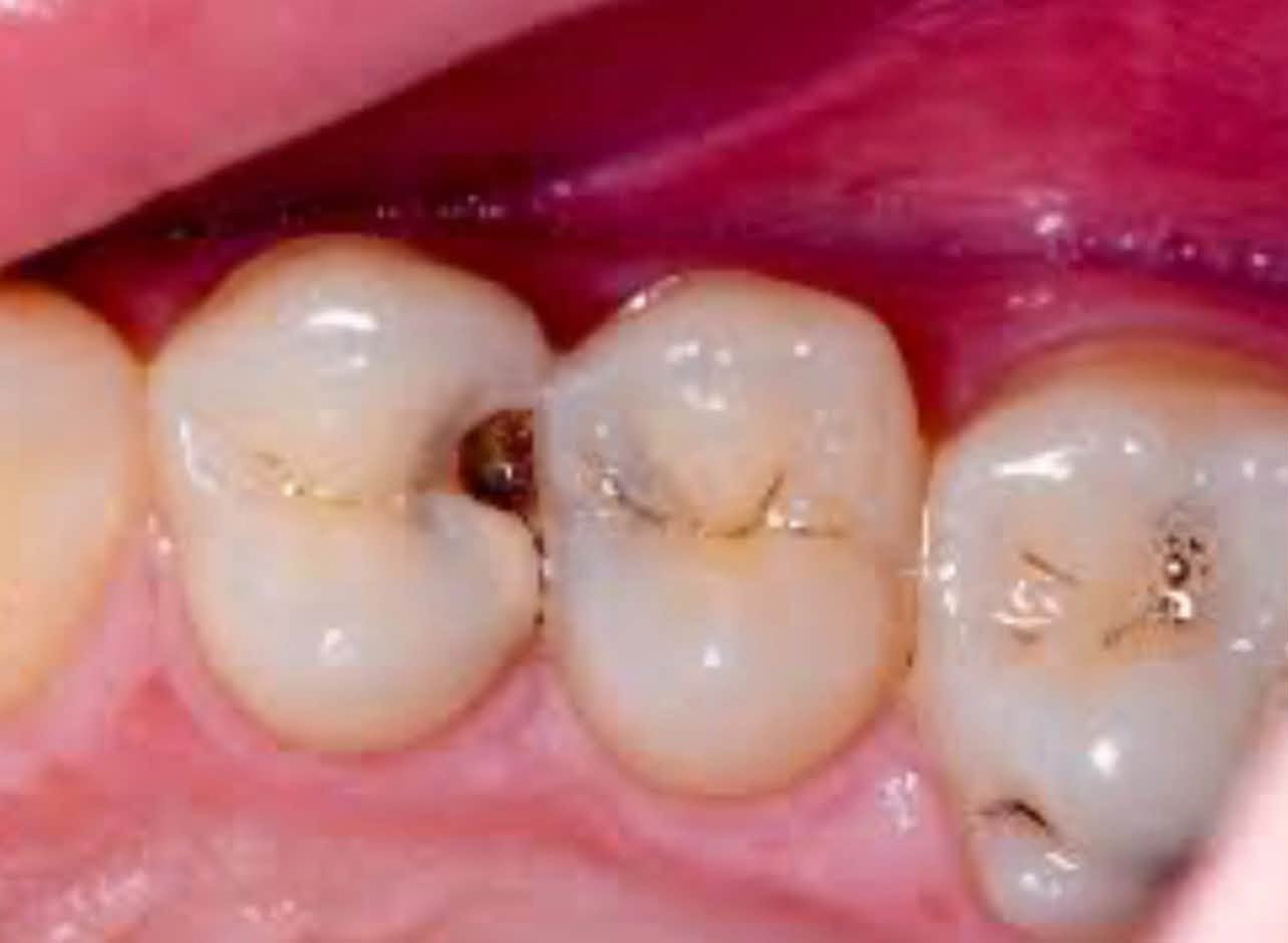 علاج مجاني وبإشراف أطباء اختصاص! 🦷✨
نستقبلكم بعيادات جامعة آشور ونقدم لكم الخدمات التالية مجاناً:
• حشوات تجميلية للأسنان
• قلع الأسنان وبقايا الجذور
• تنظيف الأسنان وإزالة التكلسات
• تعويض الأسنان المفقودة بطقم جزئي
📍 الموقع: جامعة آشور - شارع المطار
📞 للحجز: ***********
📸 إنستغرام: 8mn_tr

نص مكتوب في الصور:
- A B