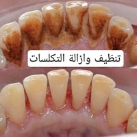 علاج مجاني • حشوة وقلع • عيادات جامعة دجلة