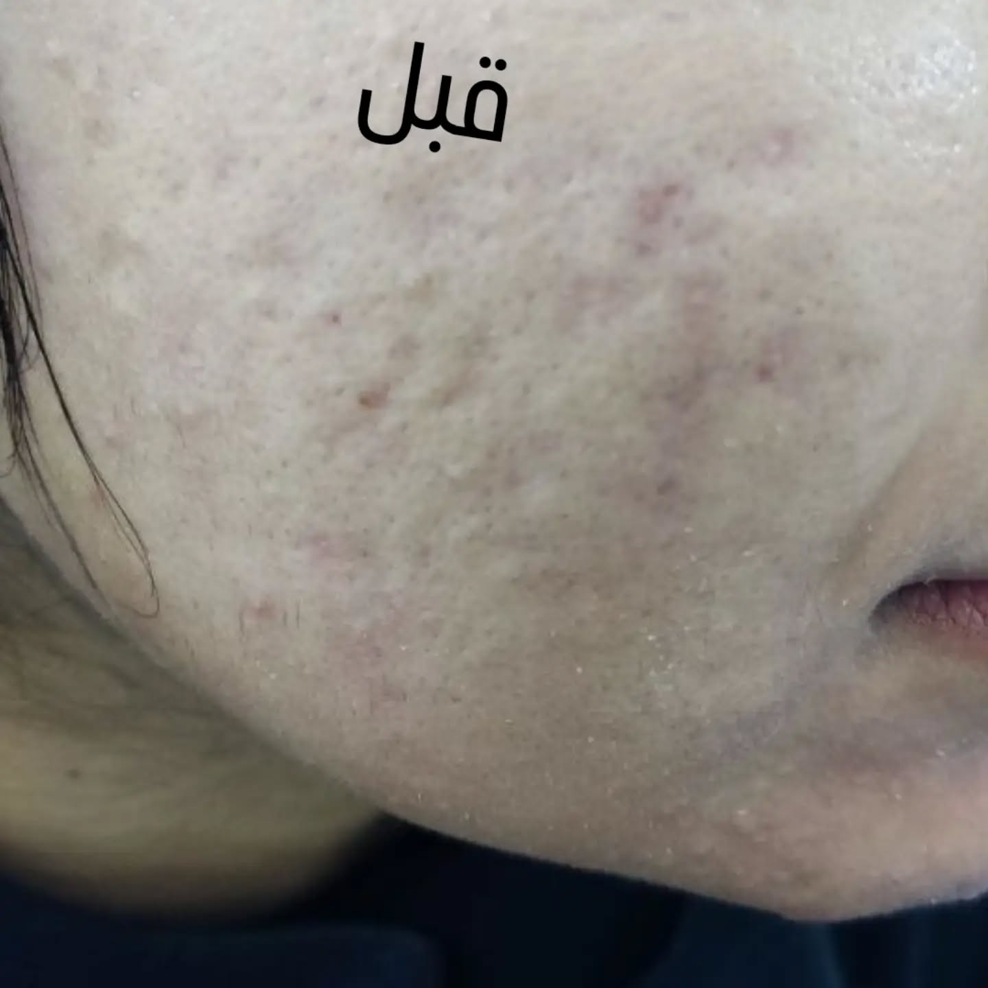 د. ساره الجبوري

نص مكتوب في الصور:
- قبل
- بعد
- د ساره الجبوري