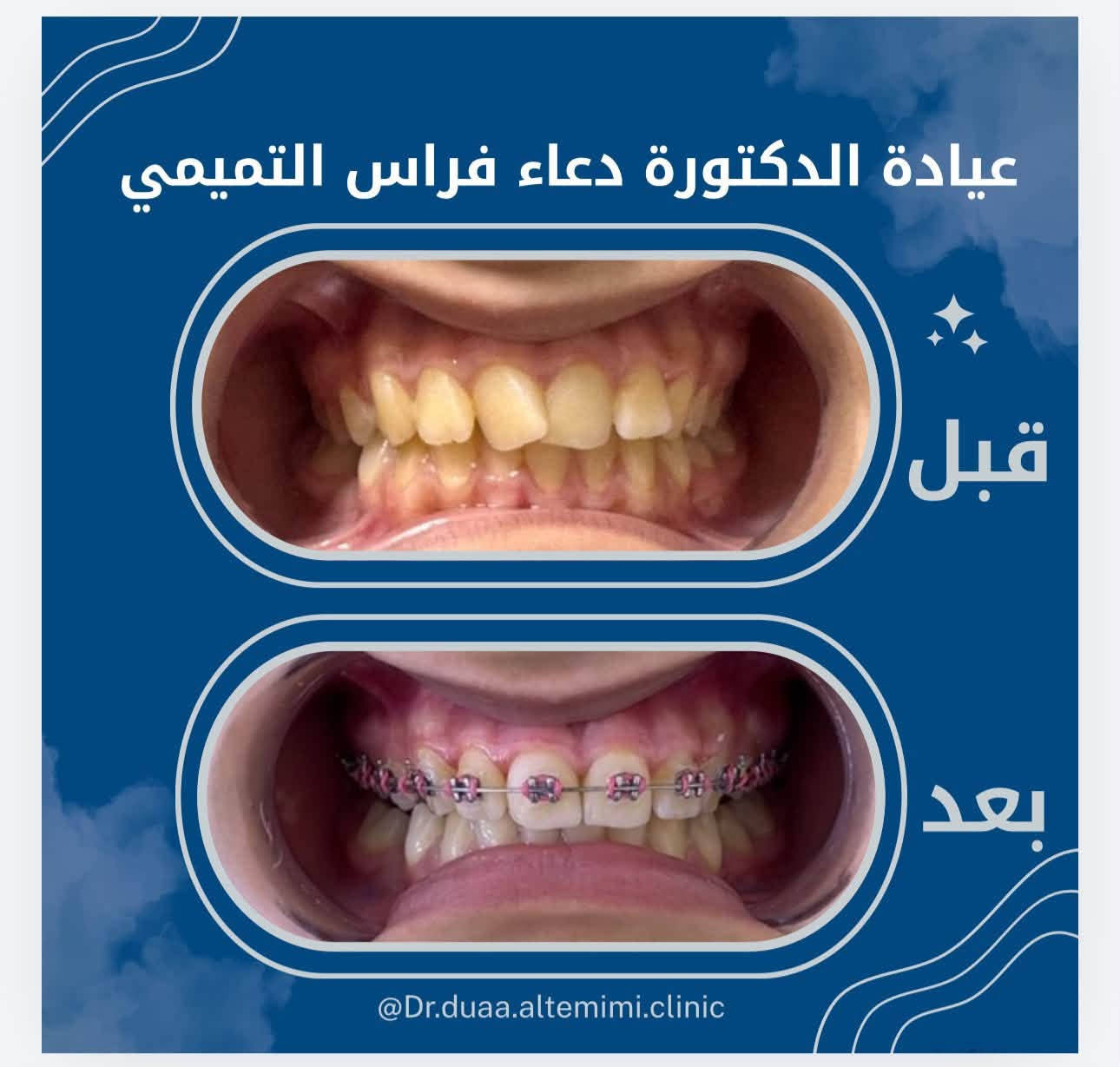 🦷عيادة الدكتورة دعاء فراس التميمي 🦷
-لعلاج الاسنان بالتقويم الشفاف والمعدني 
-زراعة الاسنان وعمل التراكيب السنية بالزاركون والسيراميك 
-عمل الحشوات التجميلية وحشوات الجذور 
-تنظيف وتبيض الاسنان بالليزر 

📍الكمالية - شارع الجامع  - مقابيل مثلجات الفريداوي 

🕠اوقات الدوام من الساعة 4 الى 2بعد منتصف الليل  جميع ايام الاسبوع 

📞للحجز والاستفسار :

***********
