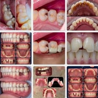 علاج مجاني • قلع • حشوات تجميلية