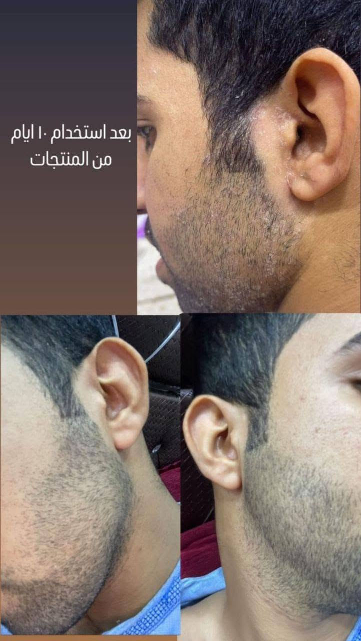 السلام عليكم :
الكتابة
✨ عناية لبشرتك… لأنك تستحق الأفضل ✨
نوفر لكم مجموعة مميزة من منتجات العناية بالبشرة للرجال والنساء 🧴💆‍♀️💆‍♂️
🇮🇷 منتجات إيرانية من شركة لدورة 🌿
💗 منتجات للنساء والرجال
💗 استشارة مجانية لاختيار المنتج المناسب
💗 متابعة الزبون كل أسبوع
💗 متابعة مستمرة وإرشادات لطريقة الاستخدام
📲 متواجدين على الواتساب للاستفسار والطلب:
***********
***********
✨ تواصلوا ويانا، والاستشارة مجانية ✨

نص مكتوب في الصور:
- بعد استعمال بكج التساقط من ماركة لدورا
- قبل بعد
- بشره تعاني من الكلف وحساسيه بالدم بعد استخدام منظف شيرباكون+مصل الكافيار لمدة ١٠ ايام
- بعد استخدام ١٠ ايام من المنتجات
- بعد
- قبل
- بعد استخدام عصاره الليكس