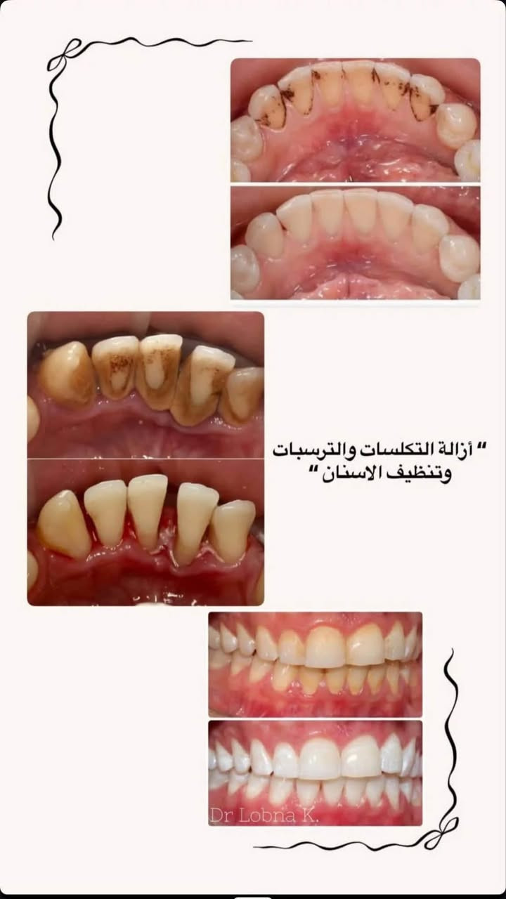 🔴 علاج مجاني 🦷 / (تحت اشراف اطباء مختصين)
الي يحب يتفضل واتساب: ***********
متوفر:  
قلع الاسنان والجذور التالفة والاسنان المكسورة  
حشوات تجميليه ( للاسنان المتسوسه والمكسورة )  
تركيب الاسنان (الطقم الجزئي لتعويض الاسنان)  
العنوان: الجامعة الوطنية للعلوم والتكنولوجيا

نص مكتوب في الصور:
- قلع الأسنان التالفة وسن العقل والجذور المتبقية
- هاي الحالات الي نستقبلها ب عيادات الجامعة " الحشوات الضوئية والتجميلية أستقبل كل حالات التسوس الموضحة بالصور "
- أزالة التكلسات والترسبات وتنظيف الاسنان Dr Lobna K.