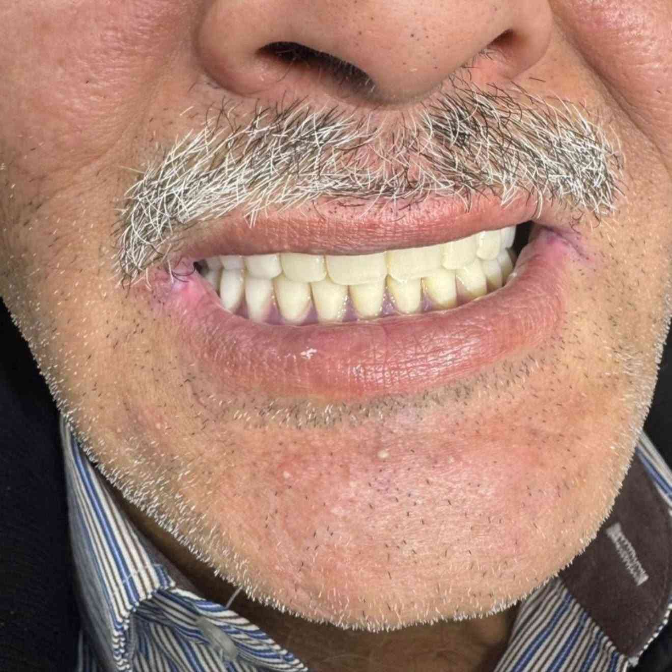 تعويض اسنان • مجاني • صور قبل بعد