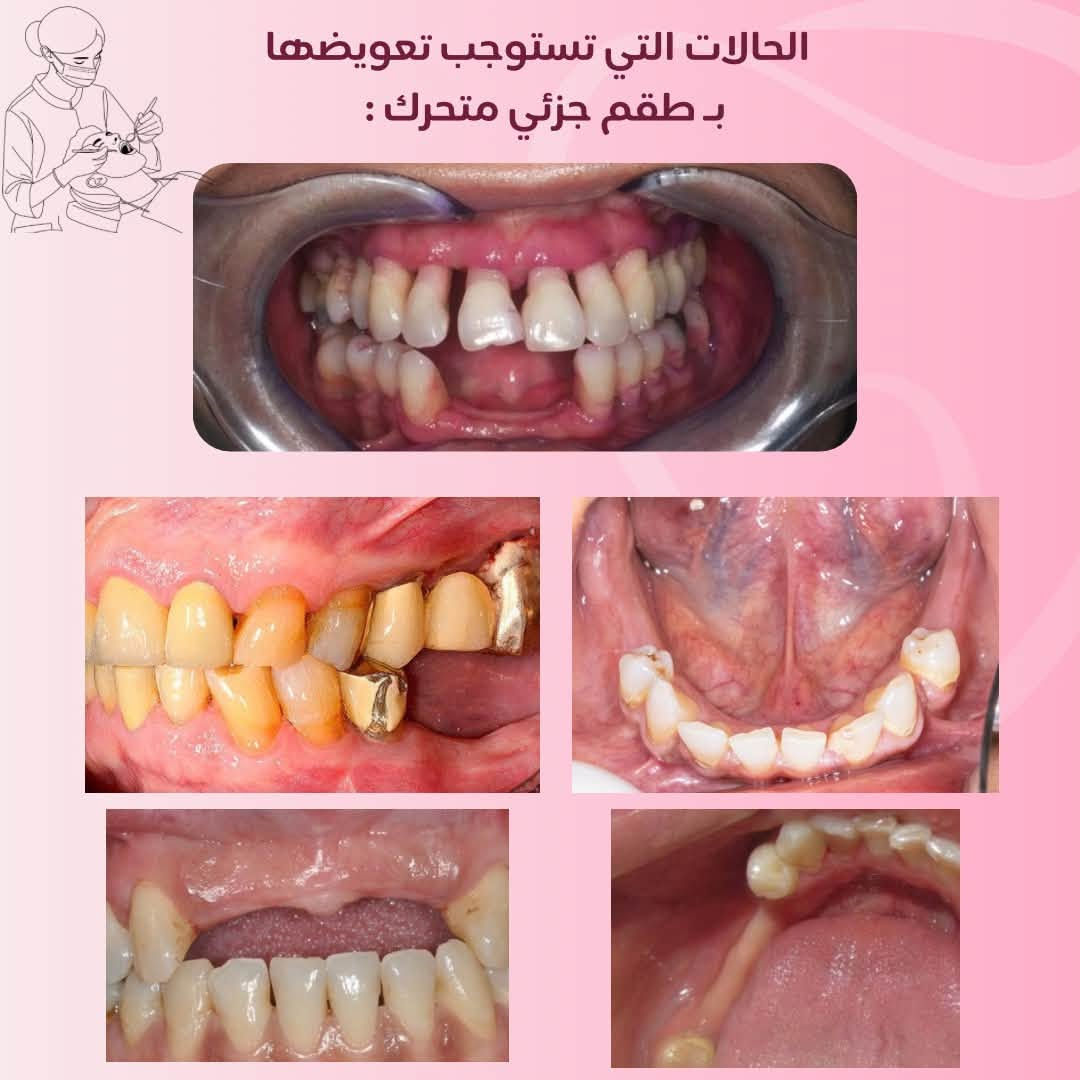 اي استفسار اني حاضرة راسلوني خاص وبعيوني 🤍

نص مكتوب في الصور:
- تجنب وجع الاسنان بالكشف المبكر د/سالي محمد خدماتنا : حشوات ضوئية علاجية للأسنان المتسوسة تنظيف الأسنان وازالة التكلسات وتبييض الأسنان تعويض الأسنان المفقودة بطقم جزئي قلع الأسنان وبقايا الجذور التالفة العلاج مجاني تحت إشراف كادر أطباء مختصين العنوان : جامعة البيان - مستشفى البيان التعليمي بغداد - شارع المطار *********** Sos19m_ Soss204
- حالات التنظيف المطلوبة
- حالات التسوس :
- الحالات التي تستوجب تعويضها ب طقم جزئي متحرك :
- الاسنان وبقايا الجذور التي تستحق القلع: