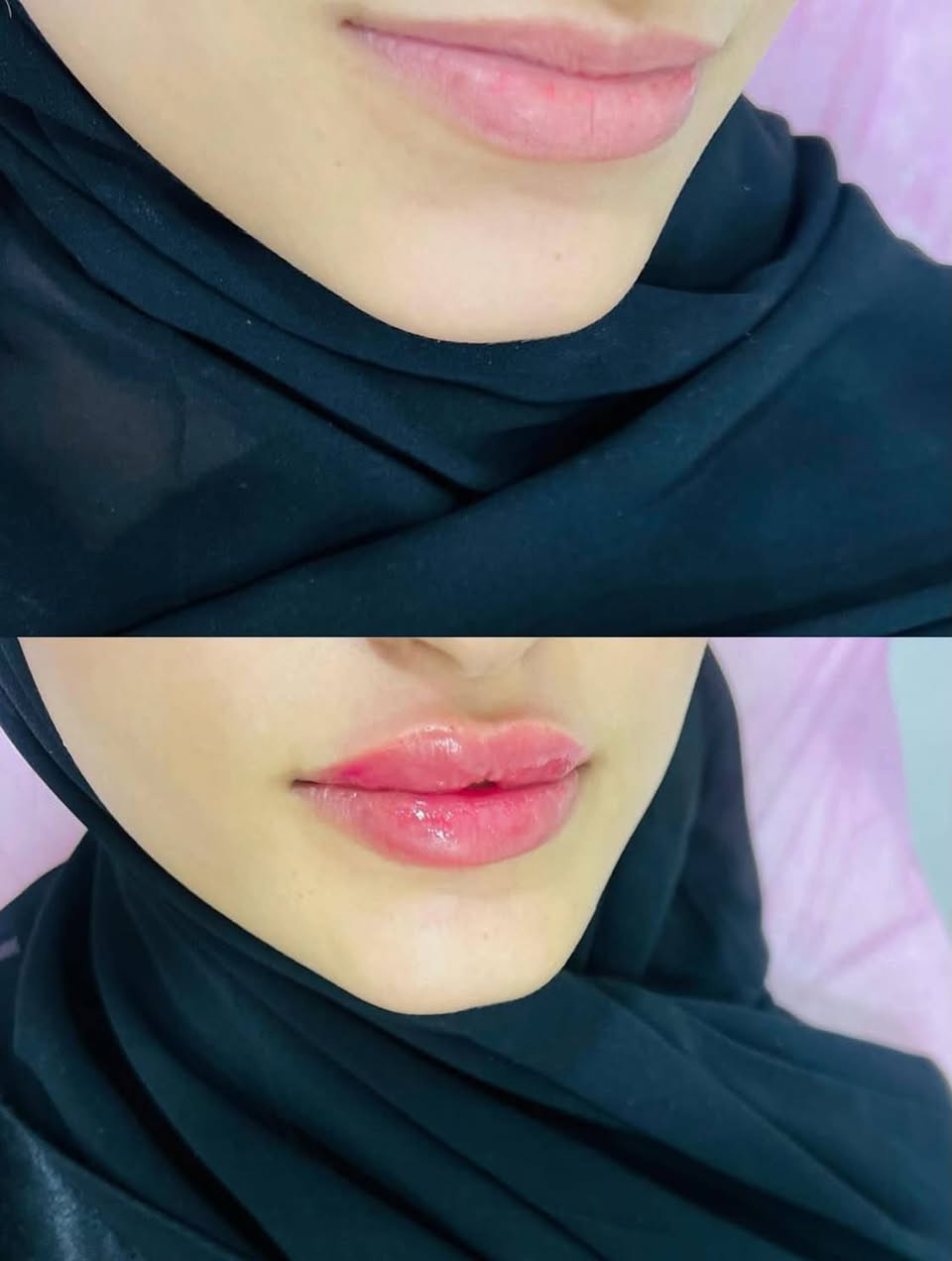 قسم التجميل اللاجراحي 
بعيادة البيان _ مقابل المنتدى الثقافي ( منتدى الشعراء ) 
الحجز و الاستفسار / ‏‪***********‬‏

