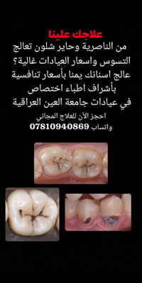 الناصرية • تنظيف أسنان • حشوات ضوئية