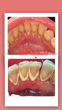 تنظيف اسنان • مجاناً • عيادات جامعة الزهراوي