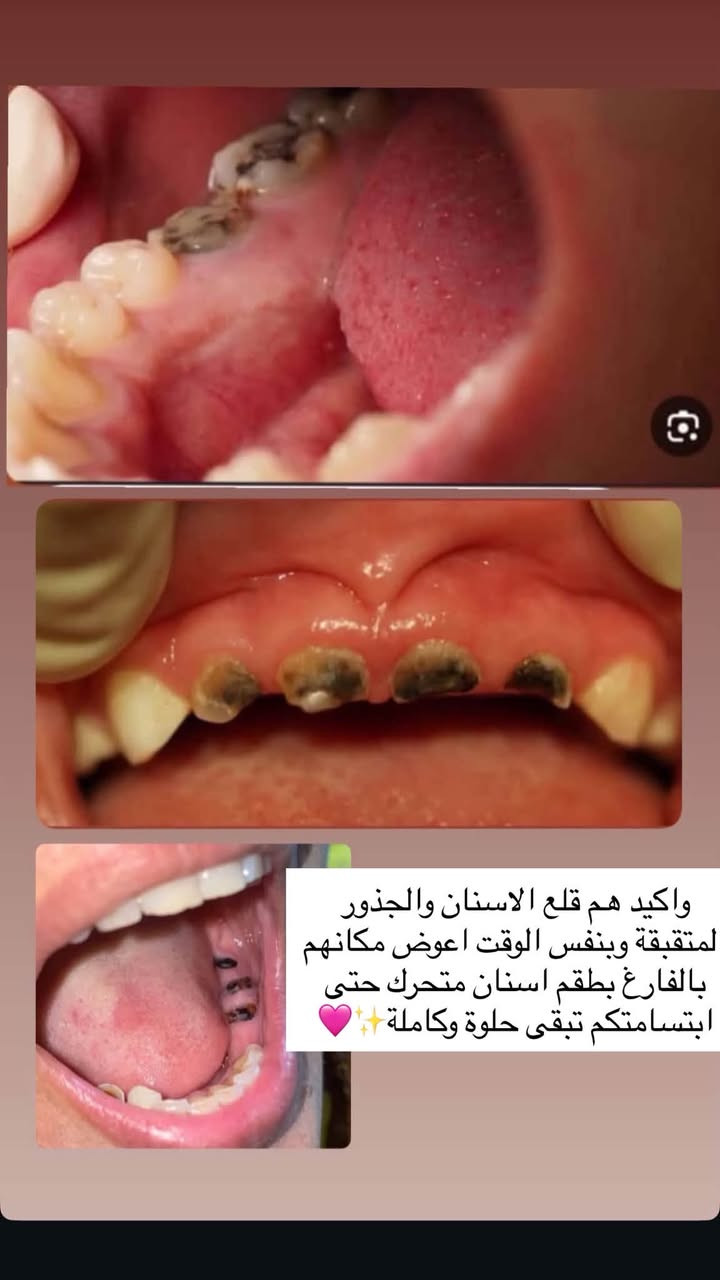 الدورة شارع المصافي • علاج اسنان مجاني • طقم اسنان مجاني
