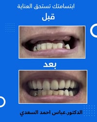 علاج اسنان • علاج مجاني • عيادة جامعة الهادي
