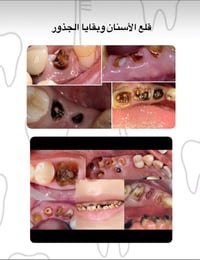 طالب طب اسنان • جامعة الموصل • قلع مجاني