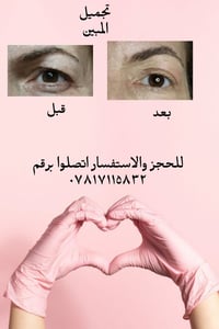 ليفت الجفن • بدون جراحة • بدون عوارض
