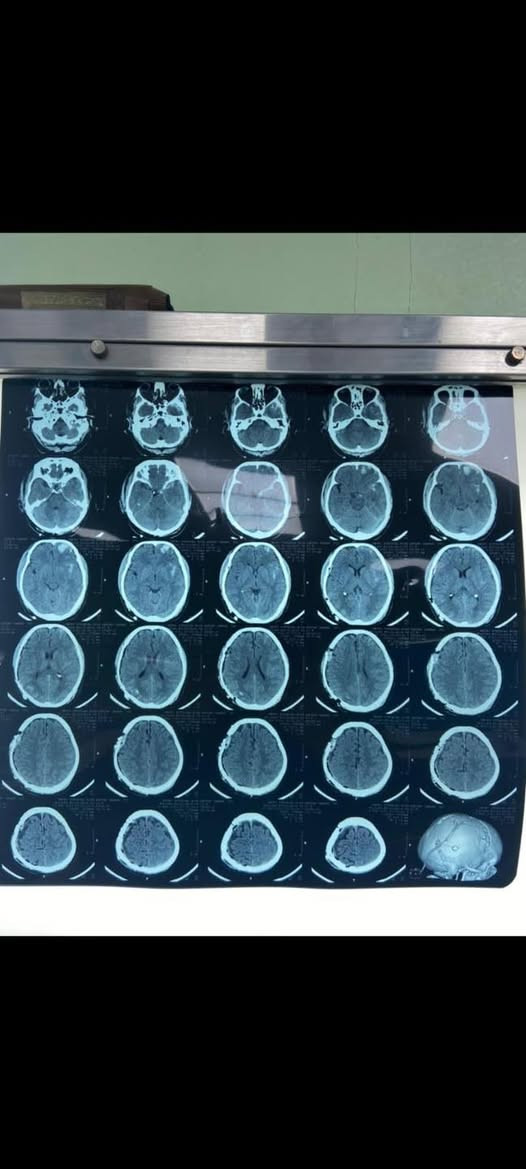 🧠 عملية ناجحة لإزالة نزف ضاغط على الدماغ

تم إجراء عملية جراحية لإزالة نزف كبير فوق الأم الجافية (Epidural Hematoma) كان يسبب ضغطًا على الدماغ، حيث تم بحمد الله إزالة النزف، السيطرة على مصدره، وإعادة عظم الجمجمة إلى مكانه.

📸 الصور المرفقة توضح المفراس قبل وبعد العملية.

👨‍⚕️ الدكتور فاروق العزاوي
   جراح  الجملة العصبية

علاج حالات الصرع • داء الشقيقة • التشوهات الخلقية • أمراض الجهاز العصبي • عمليات الدماغ والعمود الفقري • معالجة إصابات الأعصاب الطرفية وضعف الأعصاب.

🗓 وقت التواجد: السبت عصرًا والأربعاء عصرًا
📍 العنوان: جلولاء – قرب جكليتة ماركت
📞 ***********
