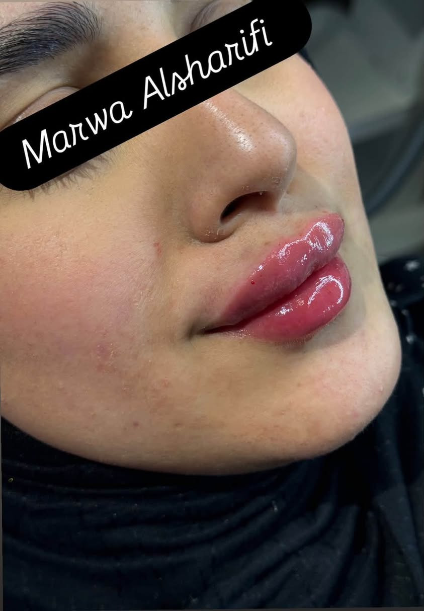 فلر شفه من تكون الرسمة على ايد مروة الشريفي  هيج تكون النتيجة 🍒💉للحجز دايركت او لاتصال على هذا الرقم *********** Marwa Alsharifi

