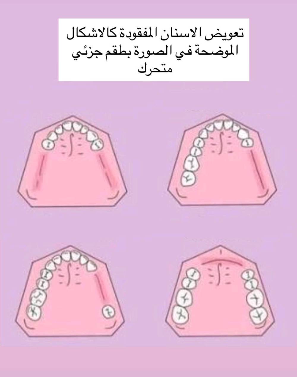 اي أحد عنده مشاكل باسنانه قلع تنظيف حشوات وطقم جزئي متحرك يكدر يراسلني ويثبت حجز وراح يكون العلاج مجاني بالكامل وتحت اشراف أطباء اختصاص 
الموقع بغداد الدورة/عيادات جامعة الهادي