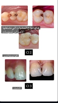 علاج مجاني • حشوات تجميلية • يرموك كلية الحكمة
