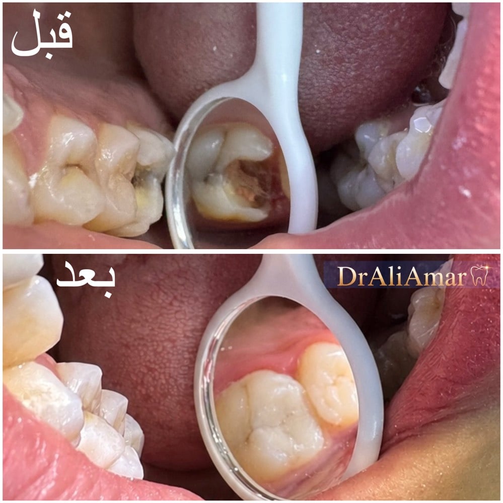التنظيف لأول جلسة مجاني 🦷🤍
والذي يميزنا عن باقي العيادات نستقبل حالات الطوارئ لمدة 24 ساعة 
ورقم الطوارئ وللحجز والاستفسار : ***********
الموقع📍:الحسينية_الراشدية / مقابل الحاج الحسن ومجاور لمصور الزهور
#dentist #doctor #الحسينية #مطعم_الامير #طب_اسنان
