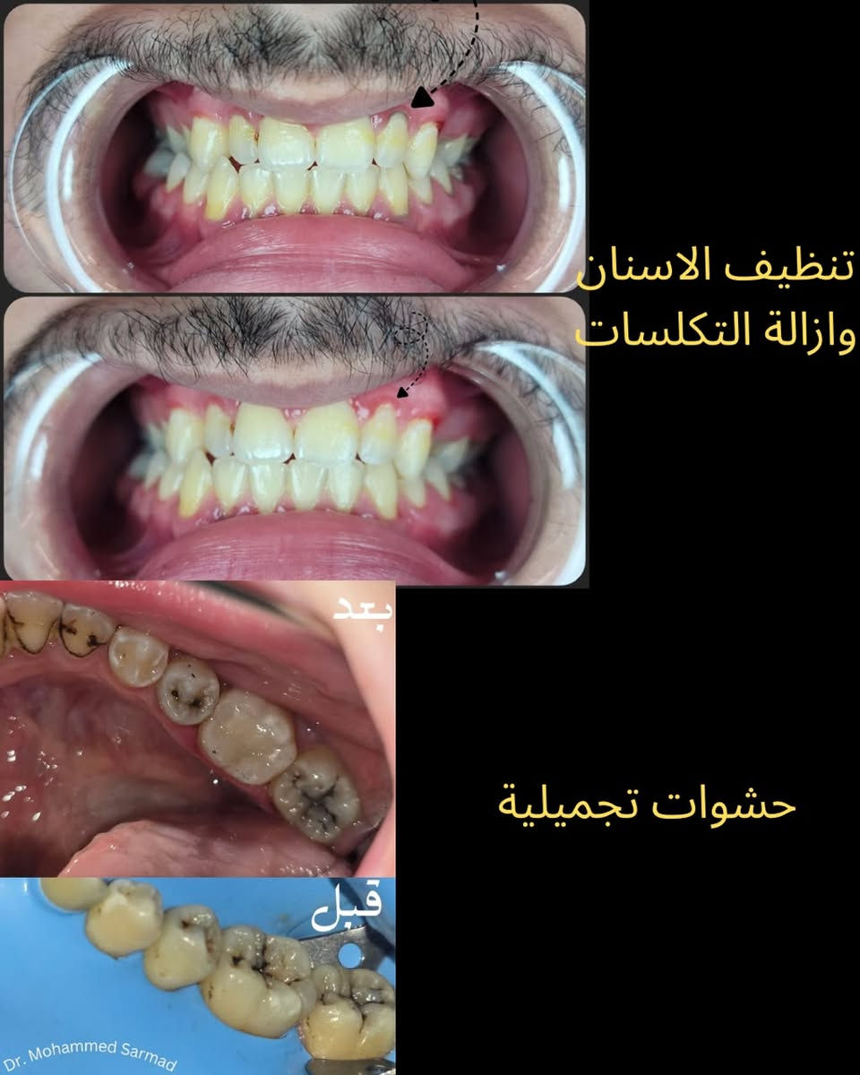 فرصة علاج الأسنان في عيادات الجامعة الأمريكية
فحص وتشخيص الاسنان
حشوات التجميلية للاسنان الامامية والخلفية
حشوات جذور 
اعادة علاج حشوات الجذور الفاشلة
تنظيف الاسنان
تغليف الاسنان بغلاف الزاركون والايماكس
تراكيب ثابتة (جسر)
تراكيب متحركة (تخم اسنان كامل اوجزئي)
اشعة ثنائية الابعد OPG وثلاثية الابعاد CBCT
زراعة اسنان
عمليات زراعة العظم
عمليات قص اللثة

الموقع: الجامعة الأمريكية في بغداد - شارع المطار
للحجز والاستفسار: ***********
او الضغط على الرابط الآتي للتسجيل المباشر
https://forms.cloud.microsoft/r/AQxEw7zA7F?origin=lprLink

نص مكتوب في الصور:
- WL
- Master cone
- RCT for #25
- After obturation
- علاج حشوات الجذور
- تنظيف الاسنان وازالة التكسسات
- بعد
- حشوات تجميلية
- قبل
- Dr. Mohammed Sarmad