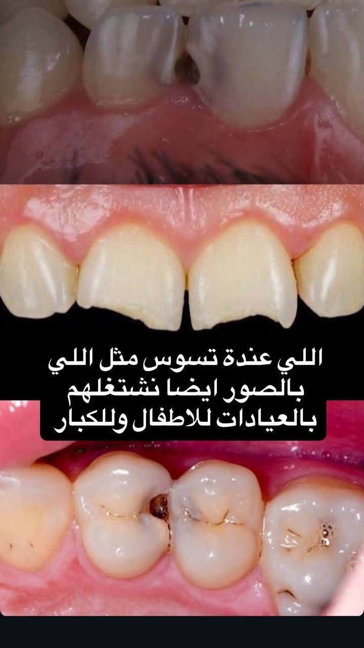 مجاناً • تسوس أسنان • اطفال وكبار