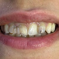 تغليف زيركون • حشوات تجميلية • ميسان الماجدية