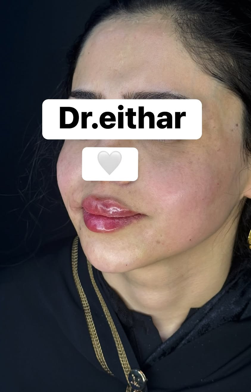 استداره الوجه كامله (لفتنك وجنات واصداغ وتدوير الفك والذقن ونظاره) والشفة🔥🔥

عروووض فرحة الزهره ثبتتهه الكم بالستوري بالهايلايت وببوست اعلى الصفحة ✨✨

د.ايثار سامي عبد الامير
واسط الكوت الهوره مجمع القبطان طابق اول 

الحجز***********
