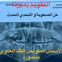 التقويم يميزنا احد حالات المعقدة و المستعصية ( الصور تتكلم عن الصعوبة)...