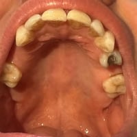 تعويض سنان • طقم اسنان متحرك • علاج مجاني