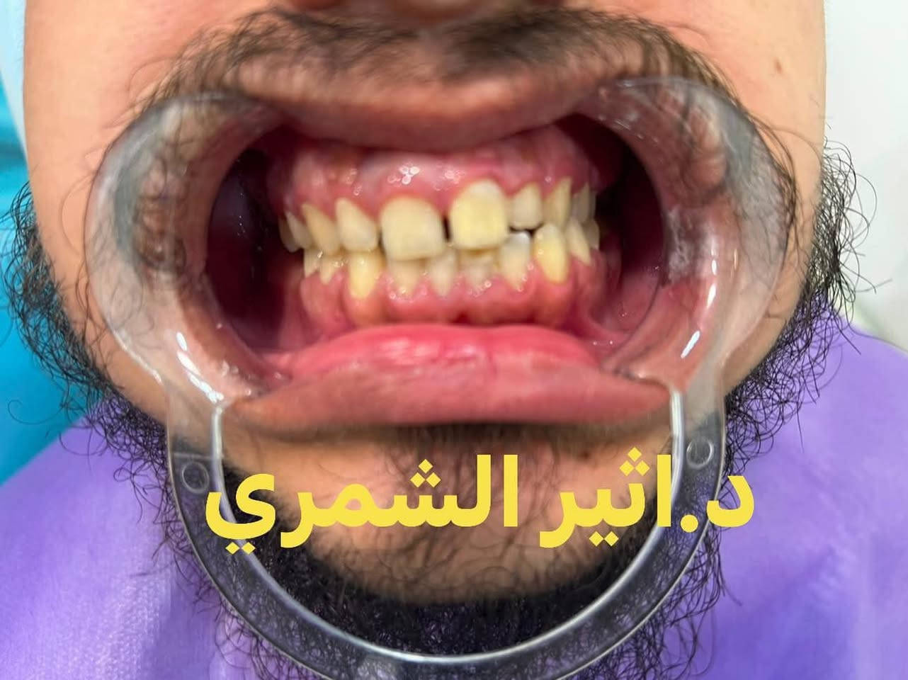 ابتسامتك المتألقة تبدأ من هنا! ✨
في عيادة الدكتورة أثير الشمري لطب وتجميل الأسنان، نمنحك الابتسامة التي تطمح إليها بأعلى معايير الدقة والجودة الطبية 💎
نمزج بين الخبرة الطبية وأحدث التقنيات لنقدم لك أفضل الخدمات:
🦷 ابتسامة هوليود وابتسامة الفينير المباشر (Composite Veneers)
🦷 تغليف وزركونيا الأسنان (Zircon Crowns)
🦷 تقويم الأسنان الشفاف (Clear Aligners)
🦷 زراعة وتجميل الأسنان بأحدث الأجهزة
🦷 تنظيف، تبييض، وعلاج الأسنان المتكامل
دع ابتسامتك تعبّر عن ثقتك! احجز استشارتك اليوم معنا.
📍 العنوان: [حي العدل/شارع الاسواق/مجاور لحوم رسول العنبر]
📞 للحجز والاستفسار: [***********]

نص مكتوب في الصور:
- د.اثير الشمري
- د. اثير الشمري
- الدكتوره اثير الشمري دايركت فينيير