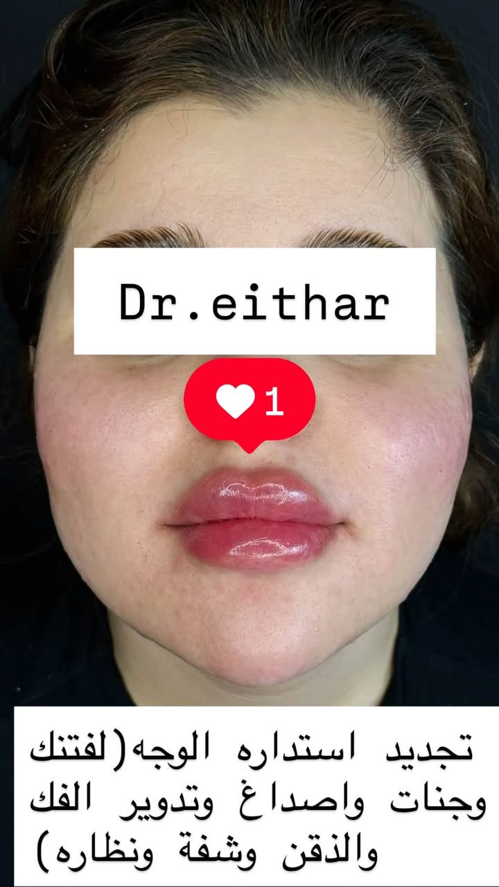تجديد استداره الوجه كامله (لفتنك وجنات واصداغ وتدوير الفك والذقن والشفه ونظاره)
الصور قبل الحقن الاول قبل سنتين تقريبا وصار تجديد  هاي ثالث مره🔥🔥

عروووض فرحة الزهره ثبتتهه الكم بالستوري بالهايلايت وببوست اعلى الصفحة ✨✨

د.ايثار سامي عبد الامير
واسط الكوت الهوره مجمع القبطان طابق اول 

الحجز***********
