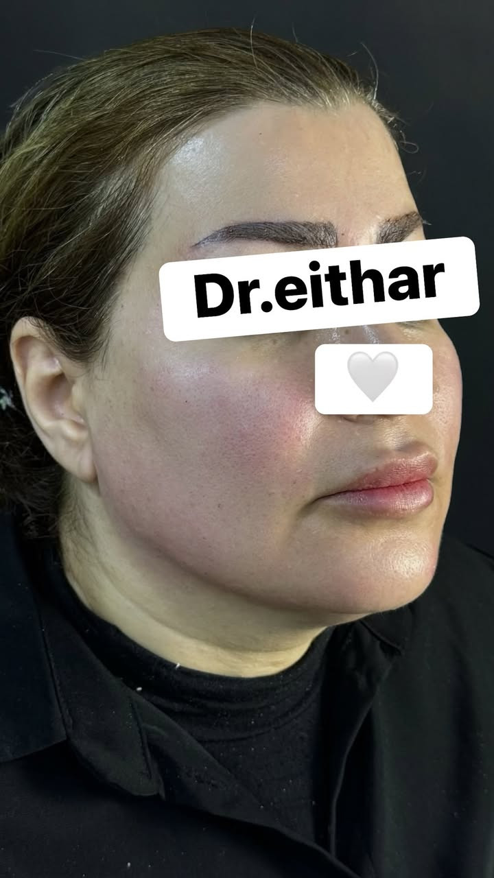 استداره الوجه كامله (لفتنك وجنات واصداغ وتدوير الفك والذقن ونظاره) 🔥🔥

عروووض فرحة الزهره ثبتتهه الكم بالستوري بالهايلايت وببوست اعلى الصفحة ✨✨

د.ايثار سامي عبد الامير
واسط الكوت الهوره مجمع القبطان طابق اول 

الحجز***********

