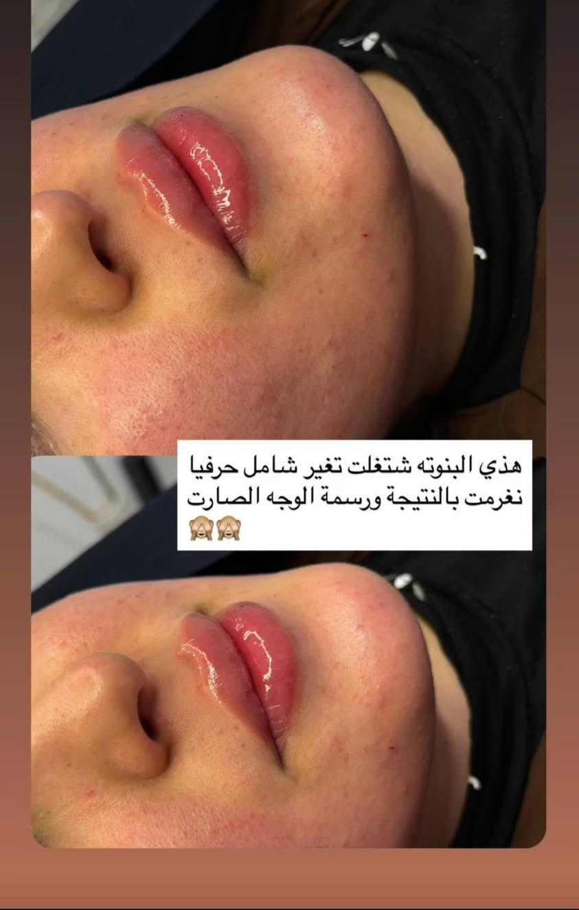 نتائج حلوه في عيادة مون لايت يوميه رسمه شكل عاشت الأيادي د ضحئ حسين كمر
العنوان الخالص للحجز مراسلة الصفحه أو الاتصال بالرقم 

***********

نص مكتوب في الصور:
- قبل د.ضحى حسين گمر
- هذي البنوتة اشتغلت تغير شامل حرفيا نغرمت بالنتيجة ورسمة الوجه الصارت 🙈🙈