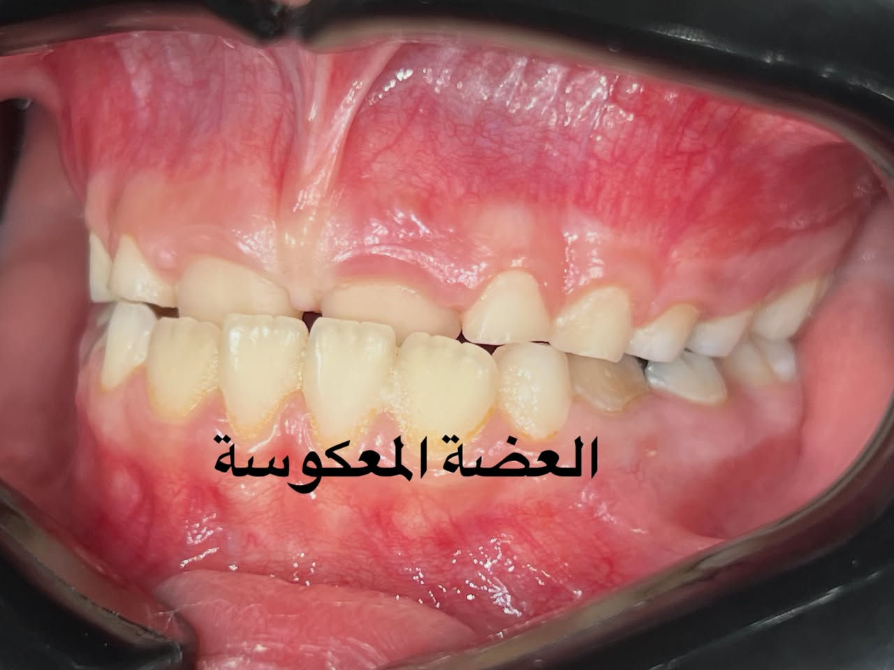 تقويم الأسنان • تقدم الفك السفلي • نفق الشرطة