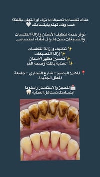 البصرة شارع التجاري • تنظيف أسنان • حشوات تجميلية