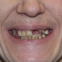 الرمادي • طقم اسنان متحرك • جامعة المعارف