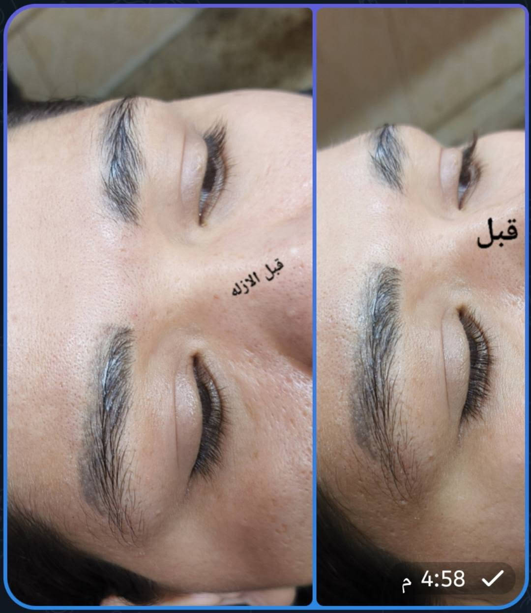 ازلاله مسح بماده حبريه امريكيه من اول جلستين وراويج من اول جلسه من بعد 20يوم اشوفين الفرق وين جان وين صار اجنن  بدون اي تأثير عل الجلداوحروق يرجع حاجبج طبيعي بشرط 👍
المدربة تاتو الكوافيره ام محمد 🧿🧿
صالون ورده بغداد 🌺🌺
والاستفسار على الواتساب 👈 ***********☎️🧿حاليا عروض 
 يلا استغلن العروض وهوواي بنات طلبو مني انزل عروض وتدللن حبايب بس لتنساني بتعليقات الله يوفقجن 😘
