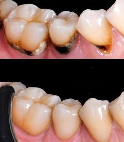 🦷 تحتاج علاج أسنان؟ نوفر لك العلاج داخل العيادة الجامعية

تتوفر حاليًا إمكانية استقبال المرضى لعلاج عدد من حالات الأسنان، بإشراف أطباء وأساتذة الاختصاص.

🔹 تنظيف وتبيض الأسنان
🔹 حشوات الأسنان الخلفية لكافة انواع تسوس 
🔹 حشوات تجميلية لعلاج كسر او تسوس الاسنان الامامية. 
🔹 علاج أسنان الأطفال
🔹فحص و علاج امراض اللثة والفم
🔹 خلع الأسنان عند الحاجة
🔹 تخم الأسنان المتحرك اذا كنت فاقد جميع الاسنان . 
🔹 حالات أخرى بعد الفحص والتقييم

📍 المكان: المستشفى التعليمي – كلية طب الأسنان جامعة بلاد الرافدين - بعقوبة -قرب تقاطع القدس. 

💰 العلاج: مجاني فقط سعر الباص. 

إذا كنت تحتاج علاجًا أو تعرف شخصًا يحتاجه، ضمن الصور المرفقة راسلنا على الخاص وأرسل:
📸 صورة الأسنان إن أمكن
📍 المنطقة
📞 رقم للتواصل

الأولوية للحالات المناسبة للإجراءات المتوفرة حاليًا.

🦷 صحتك تبدأ بخطوة بسيطة… احجز موعدك للفحص.

نص مكتوب في الصور:
- كلية طب الاسنان جامعة بلاد الرافدين رعاية متكاملة لصحة الفم والاسنان خدماتنا حشوات تجميلية وعلاج التسوس تنضيف و تلميع الأسنان قلع الاسنان علاج أسنان الأطفال صناعة وتركيب اطقم أسنان للحجز *********** ديالي,بعقوبة,قرب تقاطع القدس المستشفى التعليمي كلية طب الأسنان لجامعة بلاد الرافدين