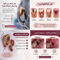 قلع اسنان • طقم جزئي متحرك • العلاج مجاني