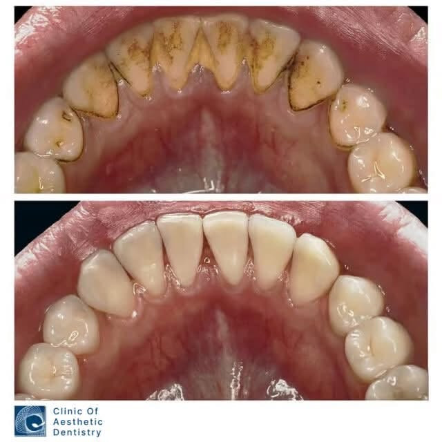 تنظيف اسنان مجاني • جامعة الرافدين • عيادة تجميل