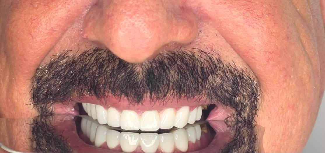 قبل 🦷

حالة كانت تعاني من تآكل وتصبغات وتفاوت في شكل الأسنان، مع حاجة لتحسين الشكل العام والابتسامة.

بعد ✨

تم إعادة تأهيل الابتسامة باستخدام قشور الزركون (Zirconia) للحصول على:
• شكل أكثر تناسقاً
• لون أكثر إشراقاً وطبيعياً
• تحسين تناسق الأسنان والابتسامة
• مظهر جمالي متناغم مع الوجه

النتيجة؟ ابتسامة جديدة بثقة أكبر 🤍

📍 كل حالة تُقيّم بشكل منفرد، ويتم اختيار نوع التعويض المناسب حسب حالة الأسنان والإطباق.
عيادة الدكتور مصطفى كمال ناصر
واسط الصويرة حي الاسرى قرب جامع وائل الشجيري مقابل صيدلية شبر 
***********/***********
