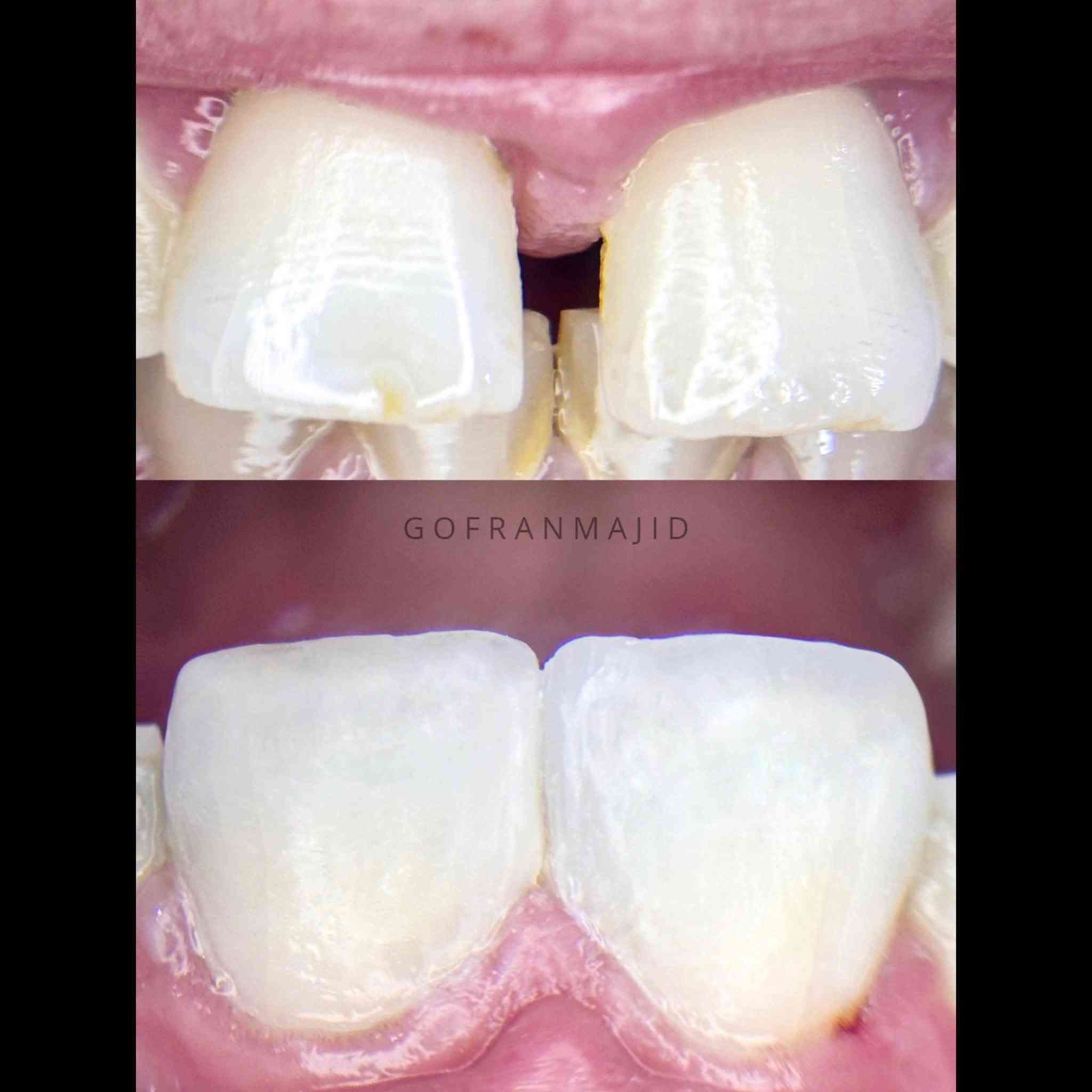 حالة غلق الفراغات بين الاسنان بالحشوات التجميلية الضوئية 😍❤️‍🔥

DrGofran Majidالدكتورة غفران ماجد 

للحجز والاستفسار مراسلة الواتساب *********** 
📍الديوانية/سومر/مجاور سيد علي للاعشاب 

Direct composite restoration for closing the distema 
Case created by dr. Gofran majid
Composite by tokuyama 

@إشارة

نص مكتوب في الصور:
- GOFRANMAJID
- GOFRAN MAJID