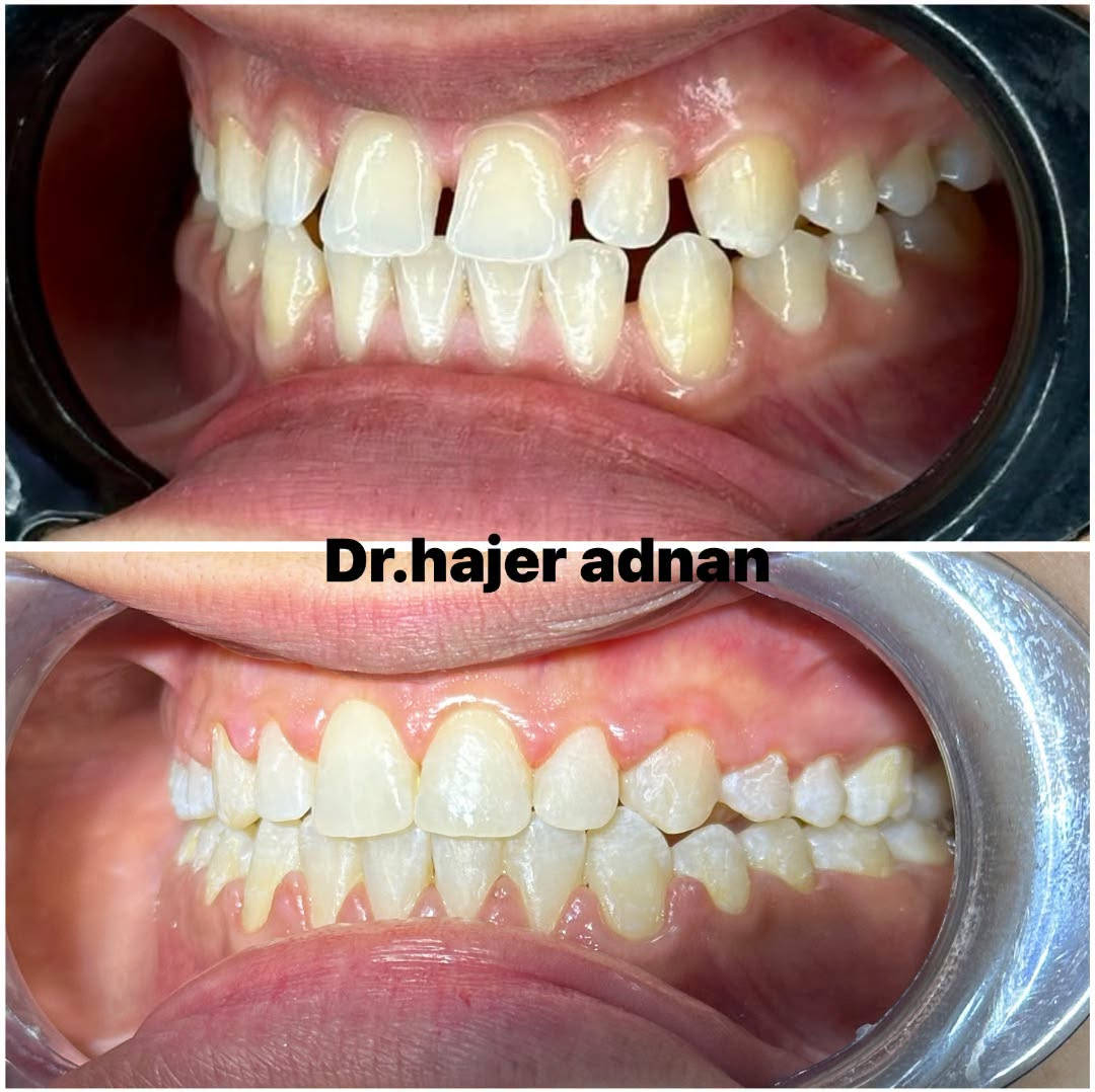 “من فراغات واضحة إلى ابتسامة متناسقة ✨🦷
بعد إكمال علاج التقويم تم إغلاق الفراغات وتحقيق اصطفاف أفضل للأسنان، لتكون النتيجة ابتسامة طبيعية وأكثر جمالًا. 🤍 
الدكتورة هاجر عدنان

نص مكتوب في الصور:
- Dr.hajer adnan