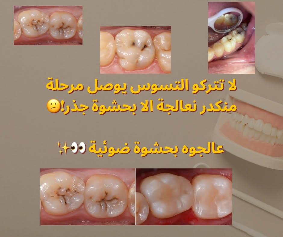 السلام علیکم
اي احد عنده تسوس او تصبغات او تكلسات او جذر متبقي او سن تالف او اسنان
بفقودة يريد يعوضهن يتواصل ويانا

[***********](tel:***********)
تليجرام 👈 Ayaa3_14@ 

موقعنا: جامعة الكوفة - قرب كلية الفقه

نص مكتوب في الصور:
- شكل اسنانكم ما عاجبكم و تريدون تسوولهن تنظيف مجاني؟ تعالوا لعيادات جامعة الكوفة
- و اذا عندكم ام او اب او اي شخص كبير بالسن و عدهم اسنان مفقودة شجعوهم حتى يسوون طقم متحرك هم سعره جدا رمزي و هم يحافظ على باقي الاسنان و هم يعوضهم اسنانهم المفقودة🥺💕
- BEFORE
- AFTER
- لا تتركو التسوس يوصل مرحلة منكدر نعالجة الا بحشوة جذر! ف عالجوه بحشوة ضوئية 👀✨
- و اي جذر متبقي او سن تالف لا تتركوه لازم نسويله قلع لان راح يجمع بكتيريا و يسوي التهاب و يضعف العظم بالمنطقة 😅
- و غيرها من الحالات اللي نعاجلها بعياداتنا ✨️🫶✨️ حافظوا على ابتساماتكم الحلوة.. خصوصا انو نقدم لكم بعياداتنا بجامعة الكوفة علاج مجاني و تحت اشراف دكاترة اختصاص 🫶