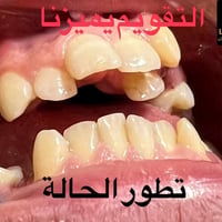 التقويم يميزنا احد اعقد و اصعب الحالات عدم انتظام و ازدحام شديد في ترت...
